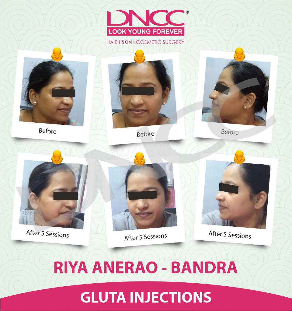Hair Transplant Transformation 1